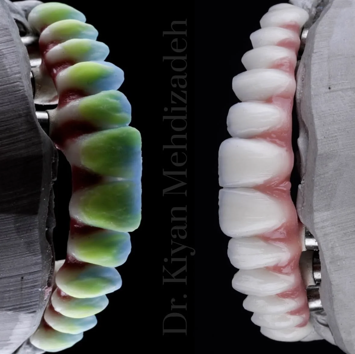 All-on-4 Dental Implants Beverly Hills | Dr. Kiyan Mehdizadeh